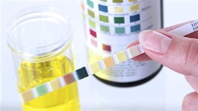 قراءة تحليل البول.. 6 دلالات مهمة للكشف الأمراض