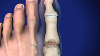 طرق علاج خشونة إبهام القدم