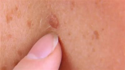 متى تكون الزوائد الجلدية سرطانية؟