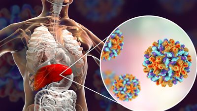 ما أسباب تشمع الكبد عند الأطفال؟