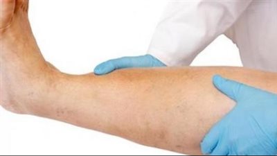  أعراض الجلطة الدموية الوريدية في الساق والذراع.. 7 علامات مهمة