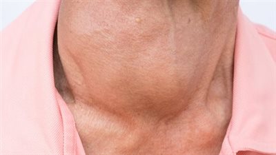 أسباب قصور الغدة الدرقية.. 5 عوامل محفزة على الإصابة