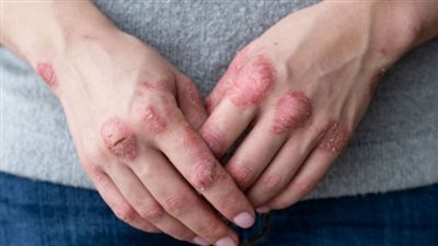 أنواع الأكزيما بالصور.. 7 أشكال مختلفة من اضطرابات الجلد تسبب الحكة