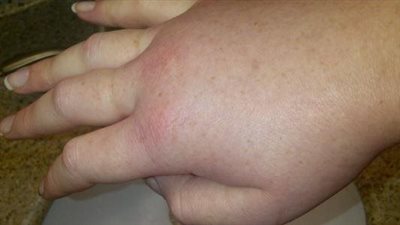 لماذا تنتفخ اليد بشكل مفاجئ؟