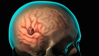 ما هو الخراج الدماغى وما علاجه؟