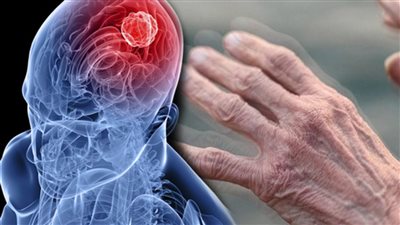 أعراض مرض باركنسون.. علامات حركية وأخرى مهمة تعرف عليها