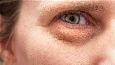 أسباب تورم تحت العينين.. فتش عن التدخين