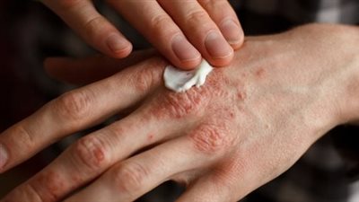 علاج الصدفية نهائيا.. نصائح منزلية وكريمات موضعية