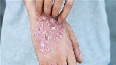 هل الصدفية معدية وكيف يمكن الشفاء منها؟.. العلاج بالضوء 