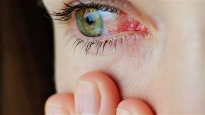 ما هى أسباب جلطة العين؟