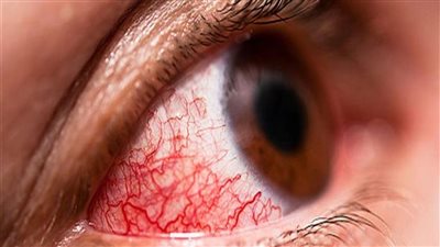 تعرف على أعراض جلطة العين