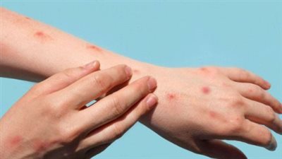 وزارة الصحة المصرية: عزل الحالة المشتبه بإصابتها بمرض جدرى القرود فور اكتشافها