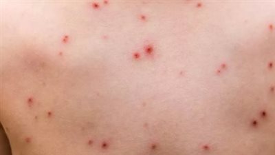 هل سيؤدي جدرى القرود mpox إلى إثارة جائحة أخرى؟