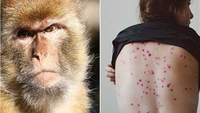 تسجيل أول حالة وفاة بسلالة 1 من جدري القرود في كندا 