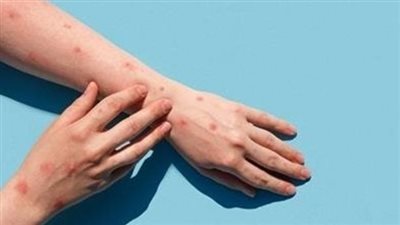 حقيقة تأجيل الدراسة بسبب جدري القرود