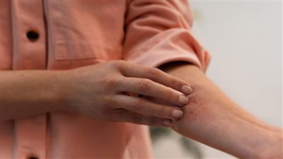 أنواع سرطان الجلد وأسبابه وعلاجاته.. احذر الأشعة فوق البنفسجية