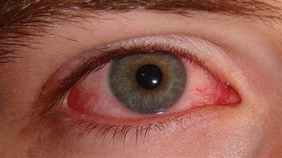 علاج التهاب العين في المنزل.. أعرف هذه الأسباب وتجنبها