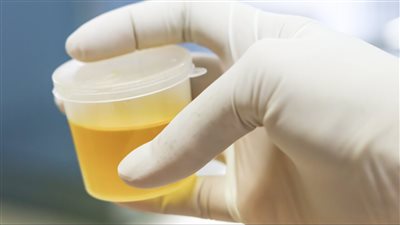 أسباب رائحة البول الكريهة.. 8 علامات خطر يجب الانتباه لها 