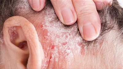 أسباب الصدفية أعراضها وعلاجها.. مرض جلدي غير معدي