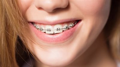 8 أسئلة تخص تقويم الأسنان.. تعرف على إجابتها قبل الذهاب إلى الطبيب