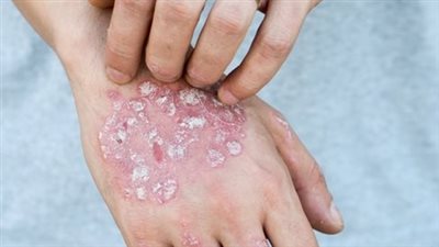 أسماء أدوية لعلاج الصدفية.. مراهم موضعية ونصائح طبية للتعايش مع المرض