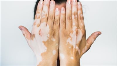 سبب البهاق.. احذر عوامل تؤدي إلى ظهوره فجأة بهذه الأعراض