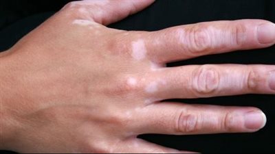 أسرع طريقة لعلاج البهاق.. أدوية موضعية وأخرى فموية ونصيحة مهمة جدًا