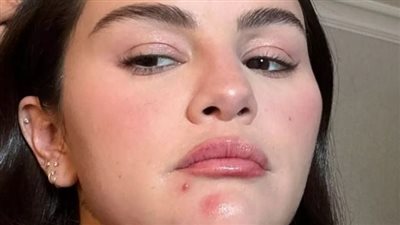  سيلينا جوميز تكشف عن حب الشباب الذي تعاني منه