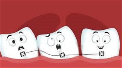 أسباب الإصابة بـ الأسنان المزدحمة.. 3 عوامل رئيسية 