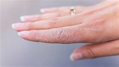 أعراض نقص الزنك.. 10 علامات يظهر بعضها على الجلد فقط