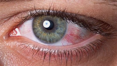 علاج جفاف العين بالقطرات الموضعية والفيتامينات الفموية