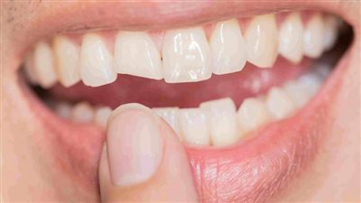 إصلاح الأسنان المكسورة.. 5 خطوات لترميمها من جديد