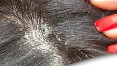 علاج قشرة الشعر في المنزل وطرق الوقاية بـ 10 خطوات فقط