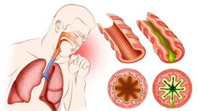 أسباب الصفير عند التنفس وكيفية التعامل معه قبل النوم بـ 5 نصائح