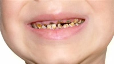 وزارة الصحة المصرية تكشف طرق هامة لحماية أسنان الأطفال