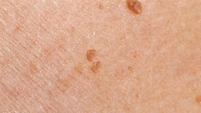 فاكسيرا تؤكد أن 99% من حالات سرطان عنق الرحم بسبب فيروس الورم الحليمى