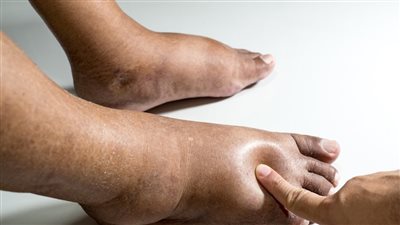 أسباب احتباس السوائل في الجسم.. 10 عوامل محفزة بعضها خطير جدًا