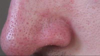 سبب ظهور الرؤوس السوداء في الوجه وكيفية التخلص منها نهائيا