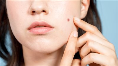 أسباب ظهور حب الشباب في الخدود وأخطر أنواعه