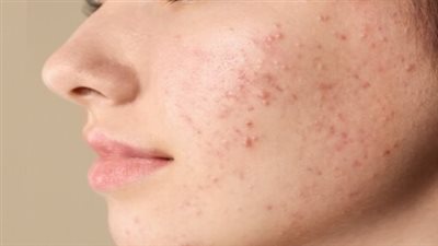 ما هو علاج حب الشباب العقدي؟.. أدوية طبية وخطوات وقائية 