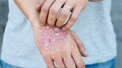 العلامات المبكرة لمرض الصدفية.. 7 أنواع مختلفة بالأعراض الأولية