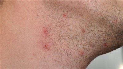 أسباب ظهور حبوب الحلاقة للرجال.. نتوءات حمراء مؤلمة