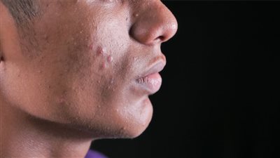 علاج حبوب بعد الحلاقة بالموس.. طريقة مثالية لحلاقة آمنة