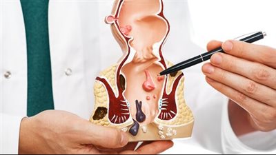 أحدث جراحات علاج البواسير.. 4 طرق علاجية