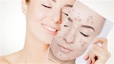 إزالة حب الشباب نهائيًا بـ 4 تقنيات تجميلية سريعة المفعول