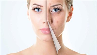 روشتة لعلاج حب الشباب.. مراهم وكبسولات مضادات حيوية 