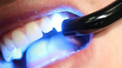 ما لا تعرفه عن حشوة الأسنان الضوئية.. مميزاته وخطواته