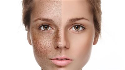 علاج النمش بالليزر.. الخطوات ونصائح مهمة بعد الجلسات