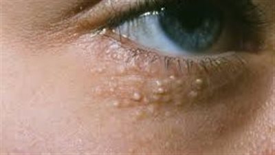 علاج حبوب الميليا تحت العين بطرق عملية سهلة وسريعة