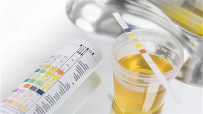 على ماذا يدل لون البول الضبابي؟.. احذر 6 حالات مرضية محفزة 